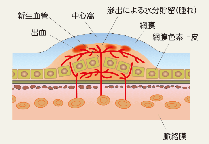加齢黄斑変性症によって新生血管が発生した黄斑の断面図