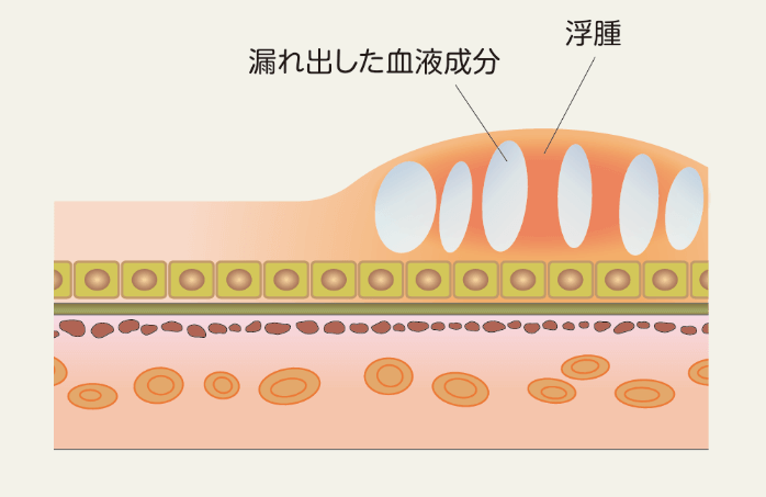 糖尿病黄斑浮腫の黄斑の断面図