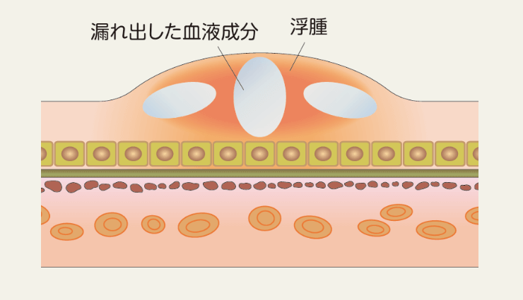 網膜静脈閉塞症による黄斑浮腫の断面図