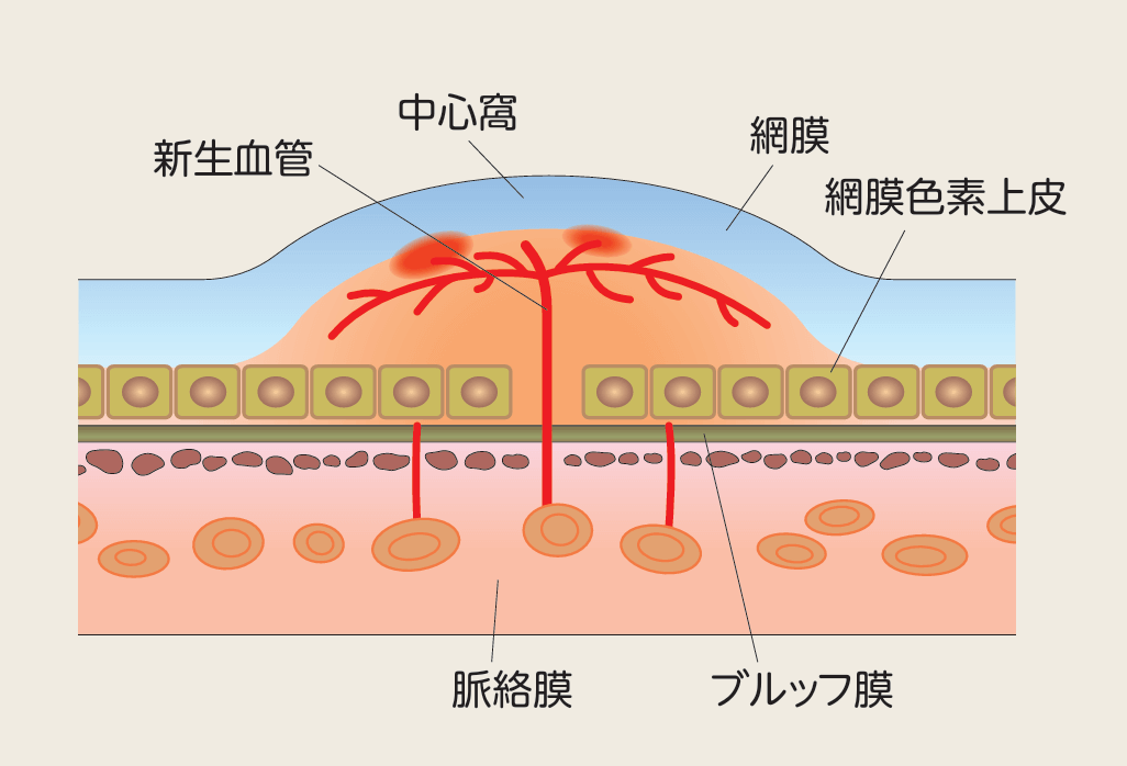 病的近視により脈絡膜から新生血管が発生した黄斑の断面図
