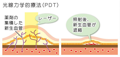 光線力学的療法（PDT：Photodynamic Therapy）の治療方法